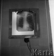 1957, Zakopane, Polska.
Zdjęcie rentgenowskie płuc pacjenta chorego na gruźlicę.
Fot. Irena Jarosińska, zbiory Ośrodka KARTA